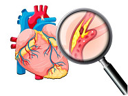 Болезни системы кровообращения лидируют по причинам смертности в Кыргызстане