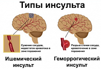 Инсульт может вызвать ряд патологических проблем